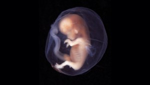 web-fetus-embryo-9-10-weeks-lunar-caustic-cc