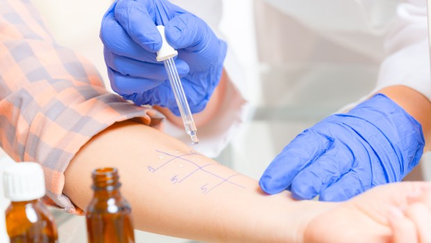 ALLERGY TEST