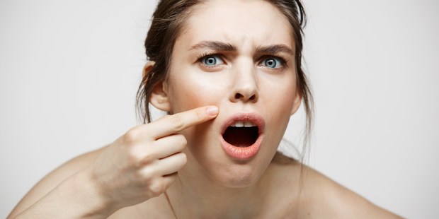 GIRL FACE ACNE