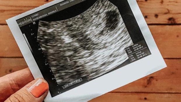 ULTRASOUND