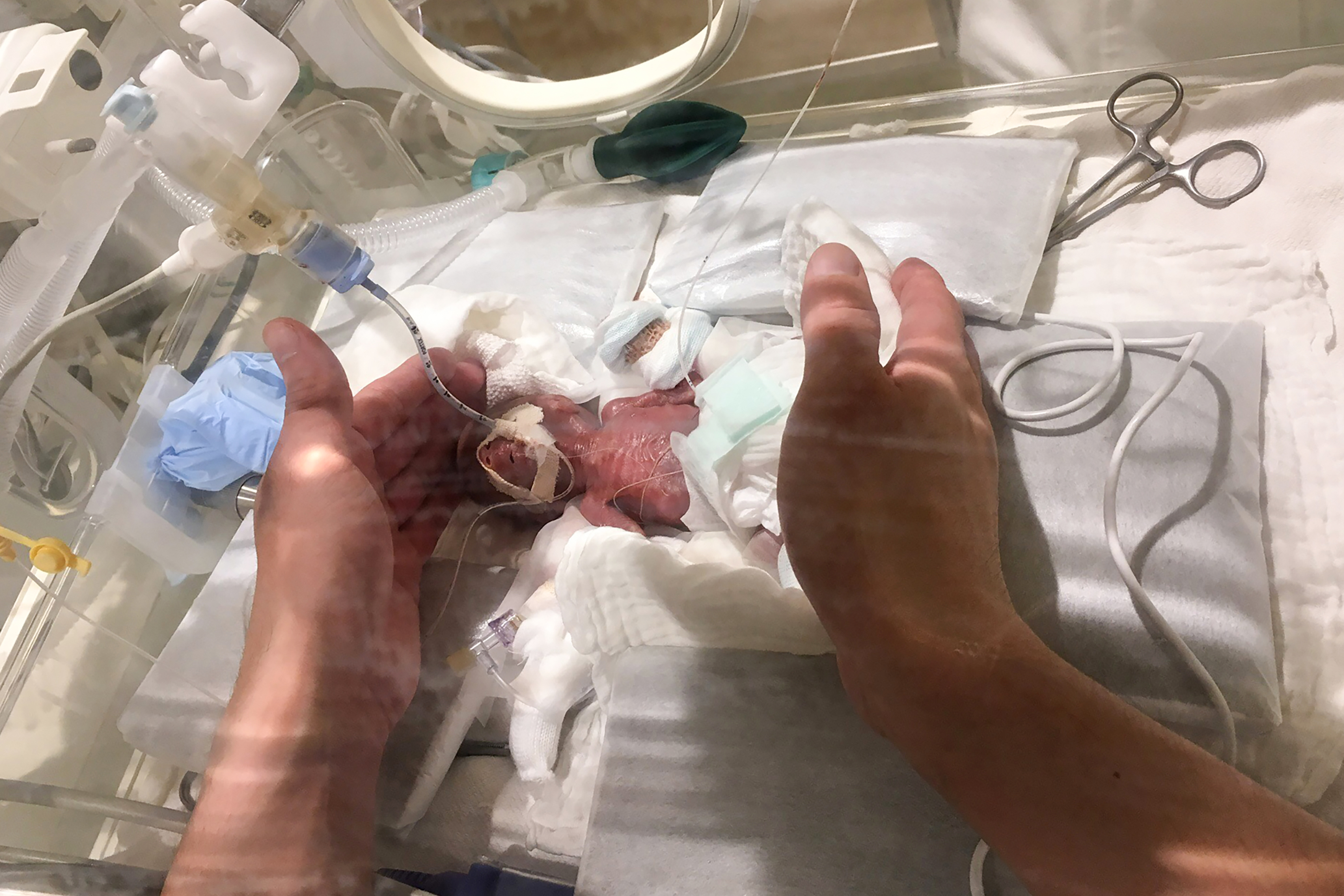 Il bambino più piccolo al mondo va finalmente a casa