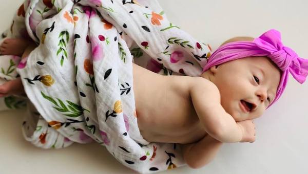 sindrome di down bambina