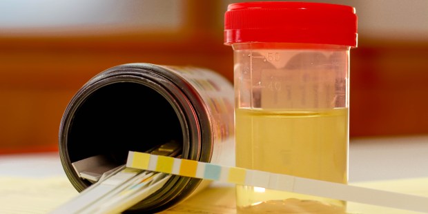 l esame delle urine per i bambini perche si fa e come si raccoglie il campione