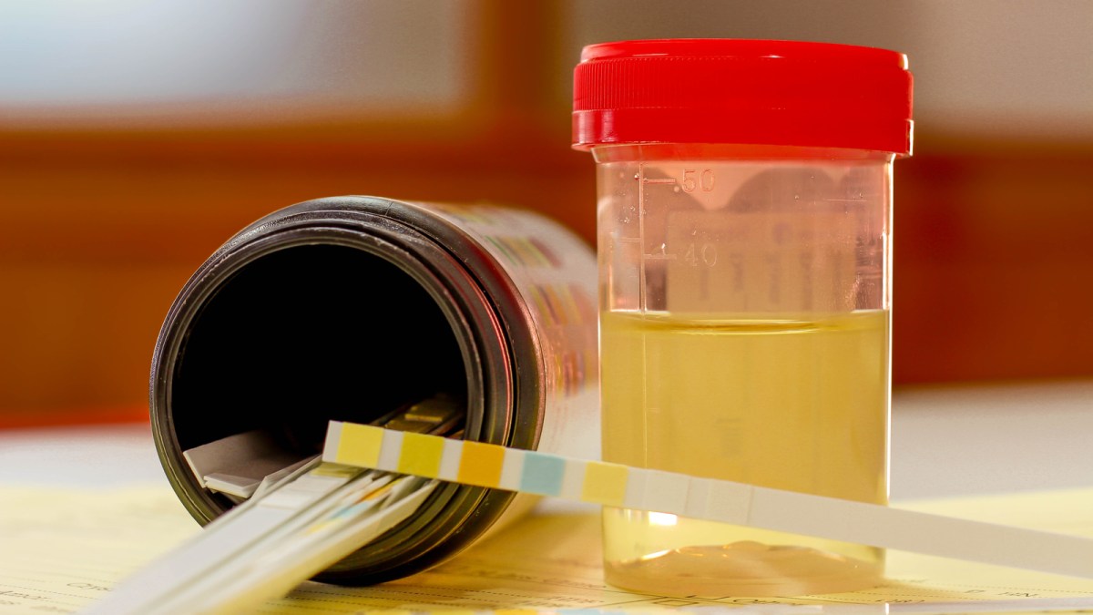 web2-urine-sample-with-reagent-strip-test-urinalysis-in-laboratory-shutterstock_567402238-.jpg