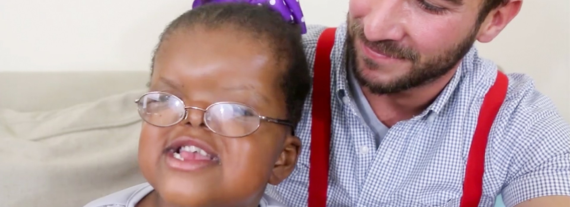 LOLA'S LIFE WITH APERT SYNDROME