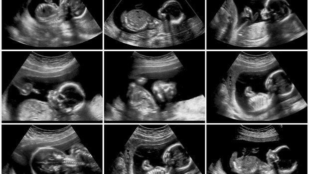 ULTRASOUND